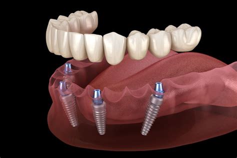 dental implants yuba city|Paramount Implant Center .